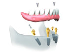 Try-in Abutment Multi Unit N-Type Set