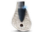 BD Cuff Fixture Normal Thread (NC)