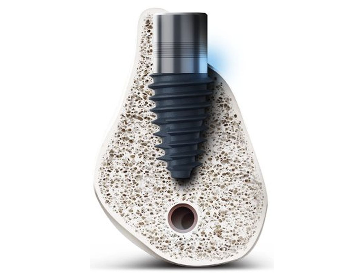 BD Cuff Fixture Normal Thread (NC)